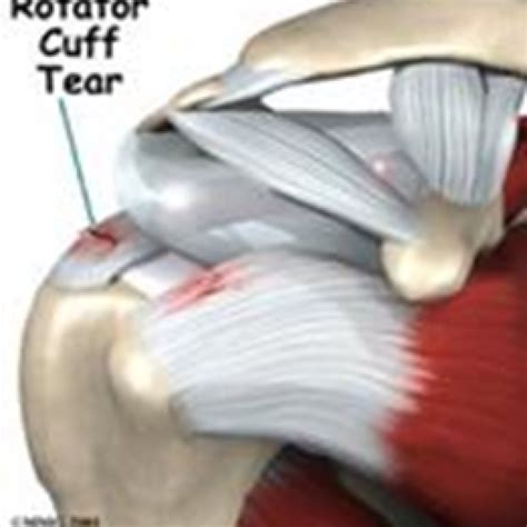 Rotator Cuff Tendinopathy Archview Physiotherapy Massage Dry