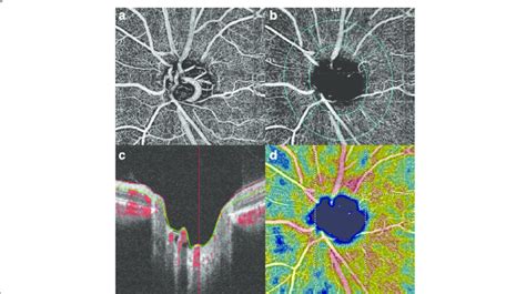 Optical Coherence Tomography Angiography Of The Left Optic Disc Download Scientific Diagram