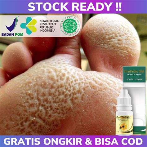 Jual Obat Tetes Kaki Rayapan Bau Obat Telapak Kaki Bolong Berlubang