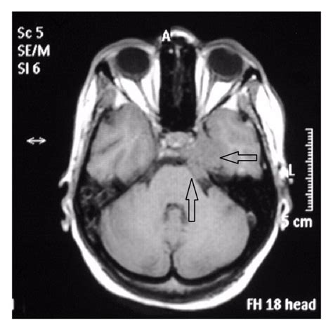 Mri Precontrast Showing Altered Signal Intensity Of The Clivus Axial Download Scientific