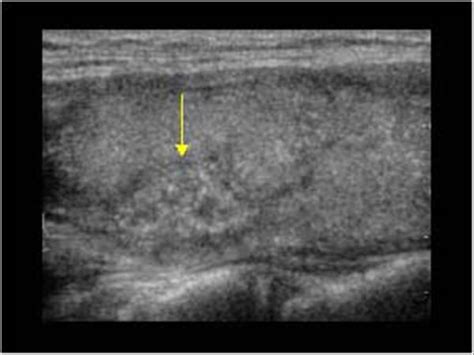 Head and Neck | 4.1 Thyroid gland : Case 4.1.3 Thyroid malignant ...