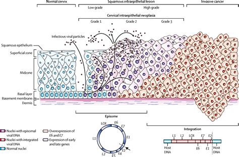 Cervical Cancer The Lancet