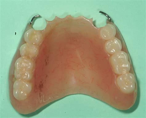 Pretreatment Upper Removable Partial Denture Pa Dental Implants