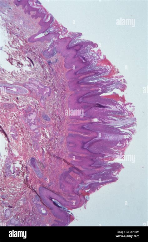 Hyperkeratosis Histology