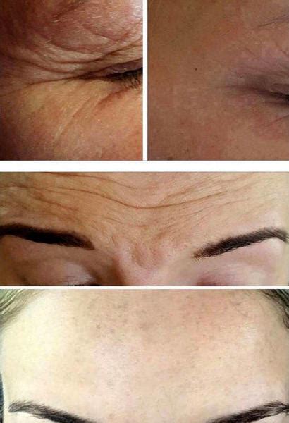 Botox Before And After Forehead (3) » Facelift: Info, Prices, Photos, Reviews, Q&A