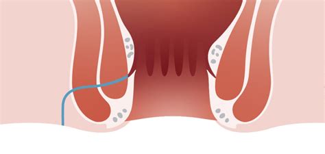 Anal Fistül Doğal Tedavi Yöntemleri Op Dr Yasir Gözü