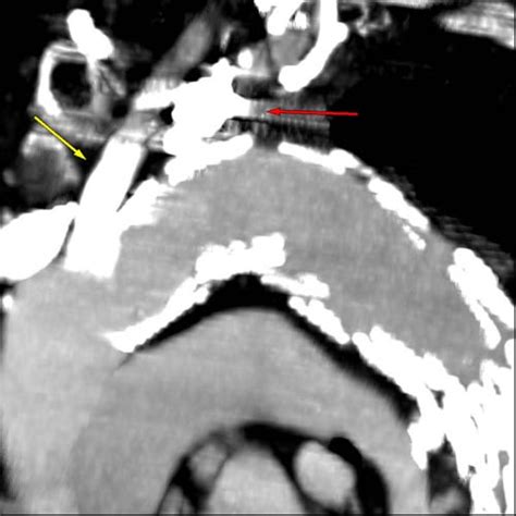 Endovascular Repair of Thoracic Aortic Aneurysms Before & After Surgery ...