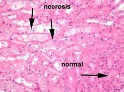 Pathology Definition Acute Tubular Necrosis Medical Zone