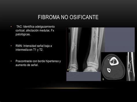 Lesiones Fibrosas Fibrooseas Y Fibrohistiociticas