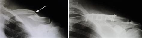 Clavicle Fracture Broken Collarbone Orthoinfo Aaos