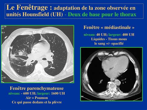 Ppt Scanner Thoracique Anatomie Du Thorax En Coupes Powerpoint