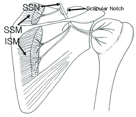 Diagram Of Suprascapular Nerve Passage Viewing From The Back Ssn