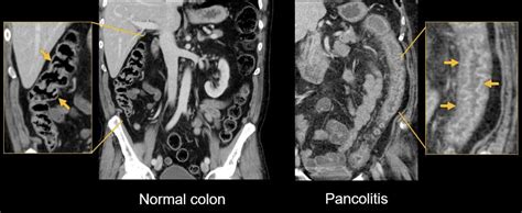 Abdominal CT Enteritis And Colitis LITFL Radiology Library