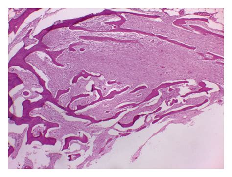 Histopathological Appearance Of Parosteal Osteosarcoma Typically Shows