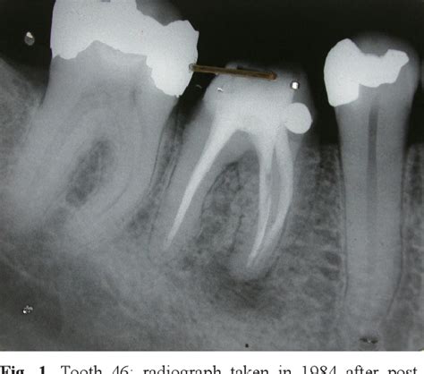 Figure 1 From Acute Apical Periodontitis And Vertical Root Fracture Of The Same Tooth A Case