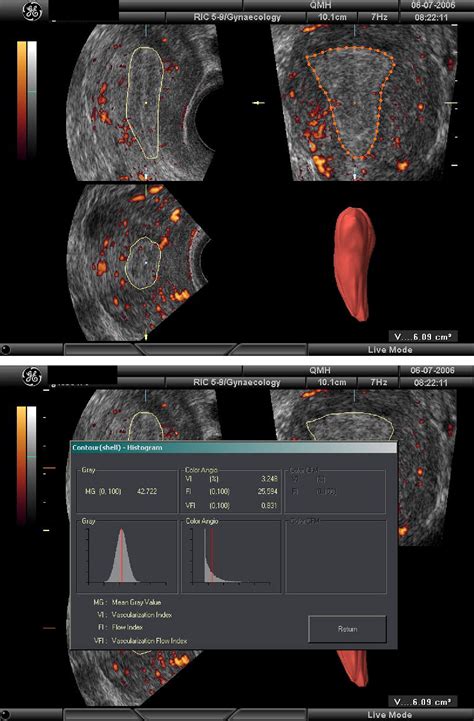 The Role Of Endometrial Blood Flow Measured By Three Dimensional Power