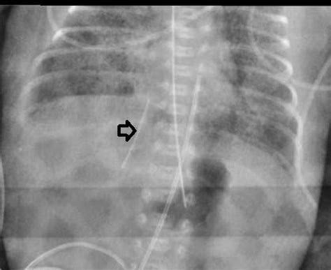 Preoperative Radiograph Demonstrating The Migration Of The Catheter