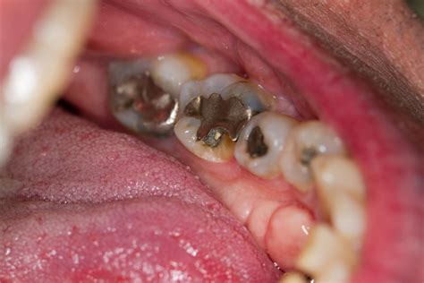 Chlorhexidine is not effective in preventing coronal caries - National ...