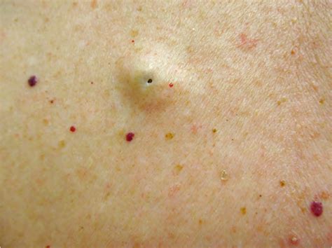 Epidermoid Cysts Diagnosis Causes Treatment Toronto Dermatology