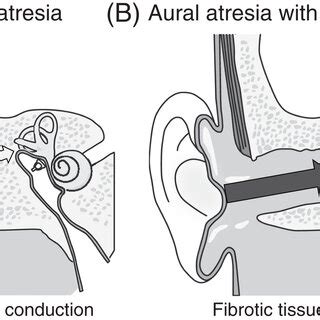 Difference in signal transmission between bony aural atresia and... | Download Scientific Diagram