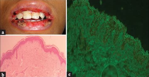 A Clinicopathological Study Of Pemphigus In Eastern India With Special