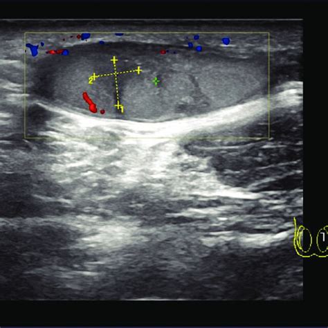 Follow Up Scrotal Ultrasound With Smaller Testicular Size With