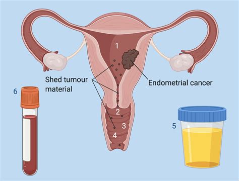 Detecting Endometrial Cancer Jones 2021 The Obstetrician