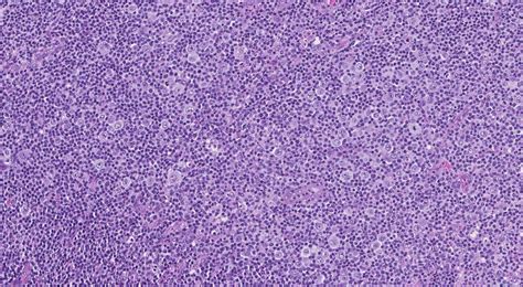 Classic Hodgkin Lymphoma Ottawa Atlas Of Pathology