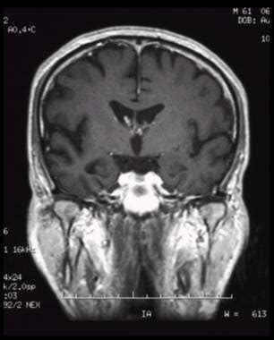 Parahippocampal Gyrus Mri