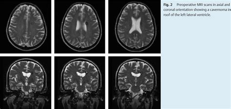 Minimally invasive cerebral cavernoma surgery using keyhole approaches ...