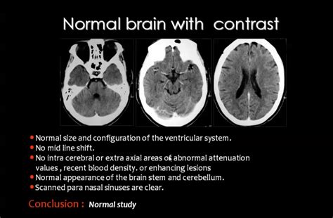 Normal Brain Ct Anatomy