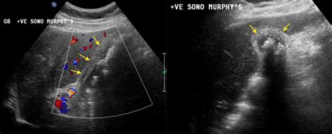 Acute cholecystitis - Radiology at St. Vincent's University Hospital