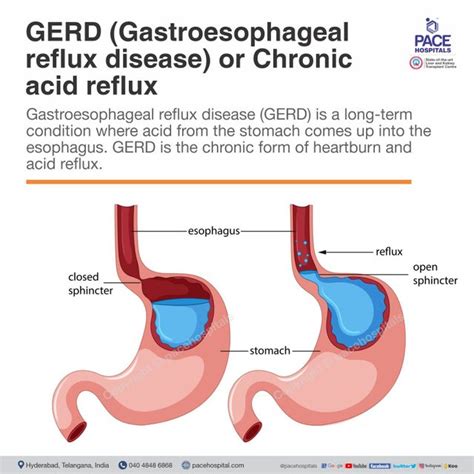 Understanding Gastro Oesophageal Reflux Disease Causes Symptoms And