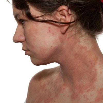 Dealing With The Discomfort Of Eczema In Dubai