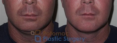 Facial Sculpting With A Silicone Chin Implant And Neck Liposuction To