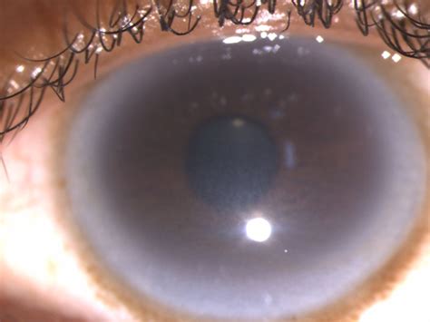 Cloudy Cornea With Arcus Juvenilis In A Case Of Dense Deposit Disease