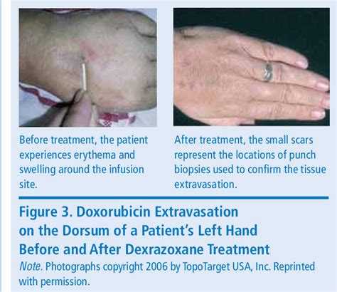 Doxorubicin Extravasation