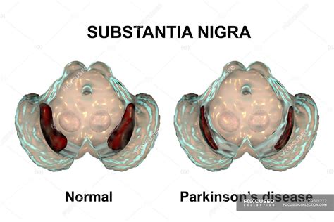 Illustration Of Healthy And Degenerated Substantia Nigra Of Human