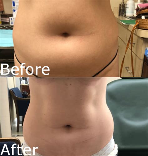 Smartlipo Laser Liposuction Treatment Hartford Ct