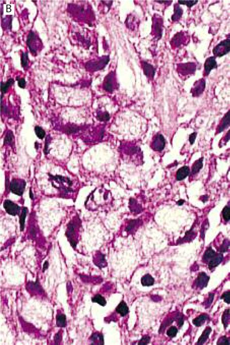 Area And Breadth Of Nuclei Of Signet Ring Adenocarcinoma Cells Vs