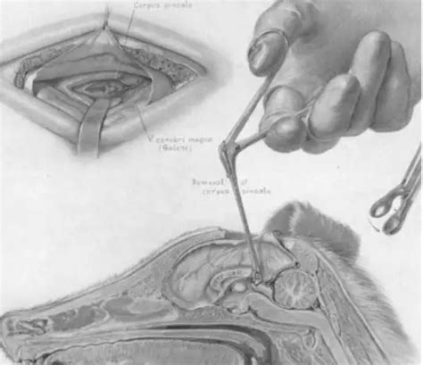 松果体区肿瘤手术入路策略与技巧 The Neurosurgical Atlas全文翻译 脑医汇 神外资讯 神介资讯