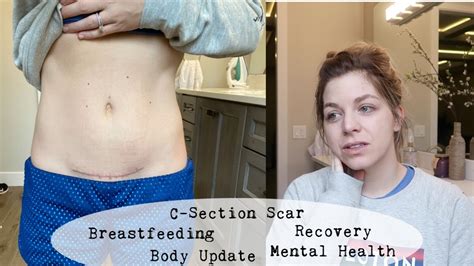 C Section Scar And Body Update Four Month Postpartum YouTube