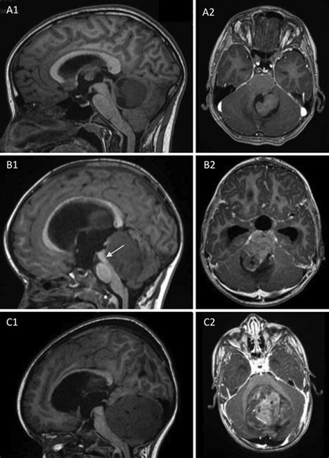 Preoperative Sagittal A B And C And Axial Gd Enhanced A B