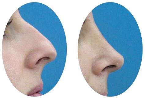 Comparison Of 1 Year Nasal Tip Projection Results Of Triple Cartilage