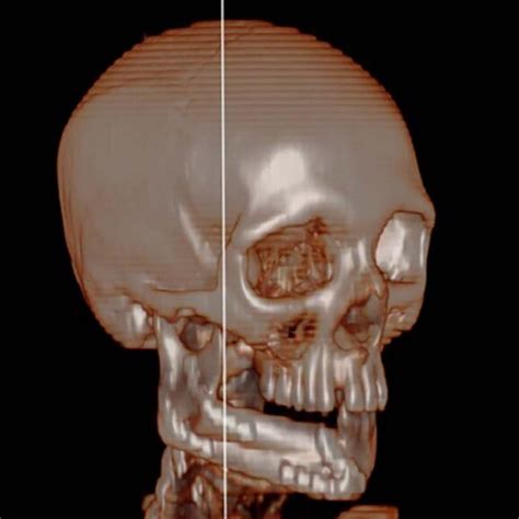 Computed Tomography 3D Rendering After 3 Months From Surgery Is