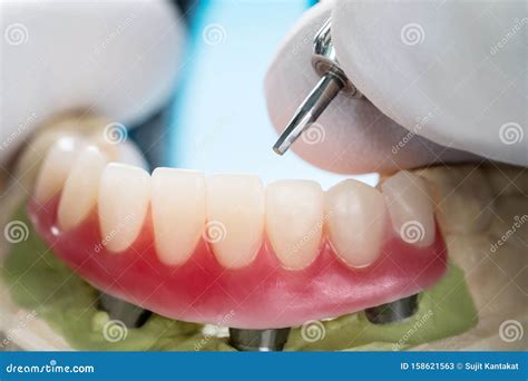 Dental Implants Supported Overdenture. Stock Image - Image of dentist ...