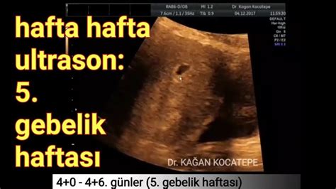 7 Haftalık Gebelik Kese Var Bebek Yok Bebekse Net