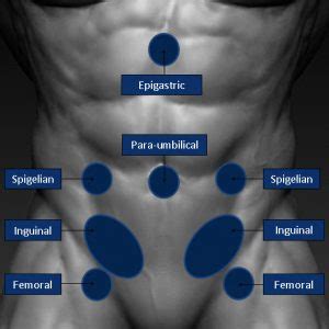 Types of Hernia – The Hernia Clinic