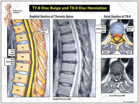 T Disc Bulge And T Disc Herniation