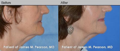 Photos Chin Reduction Before And After Dr James Pearson Facial